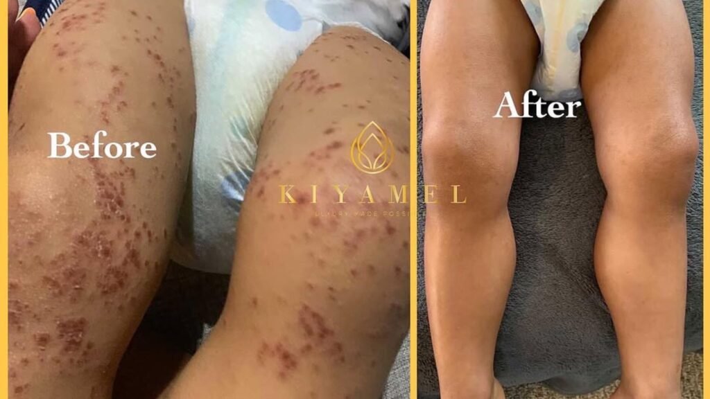 Black Mother Cures Her Daughter Eczema and Build Her Brand Kiyamel Eczema Relief